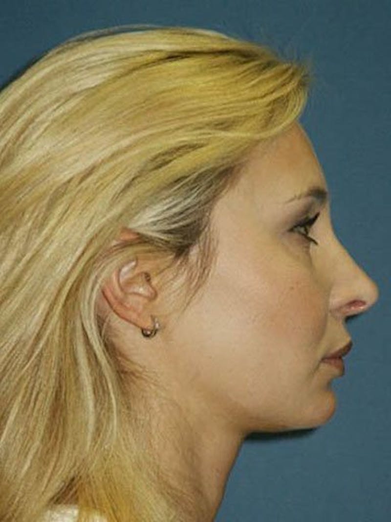 Female Rhinoplasty Before & After Gallery - Patient 17365796 - Image 4