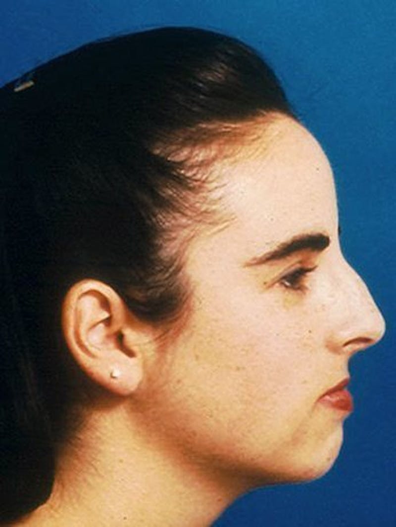Female Rhinoplasty Before & After Gallery - Patient 17365798 - Image 3