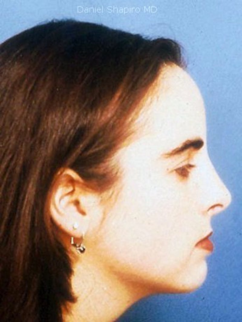 Female Rhinoplasty Before & After Gallery - Patient 17365798 - Image 4