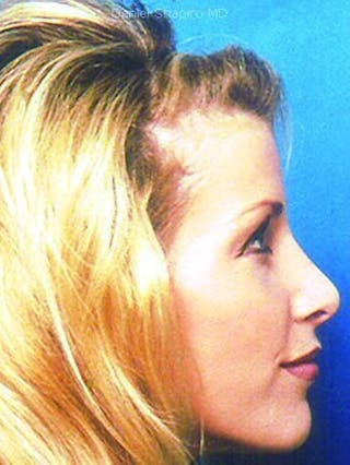 Female Rhinoplasty Before & After Gallery - Patient 17365801 - Image 4
