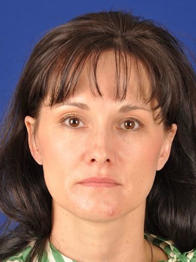 Female Rhinoplasty Before & After Gallery - Patient 17365802 - Image 1