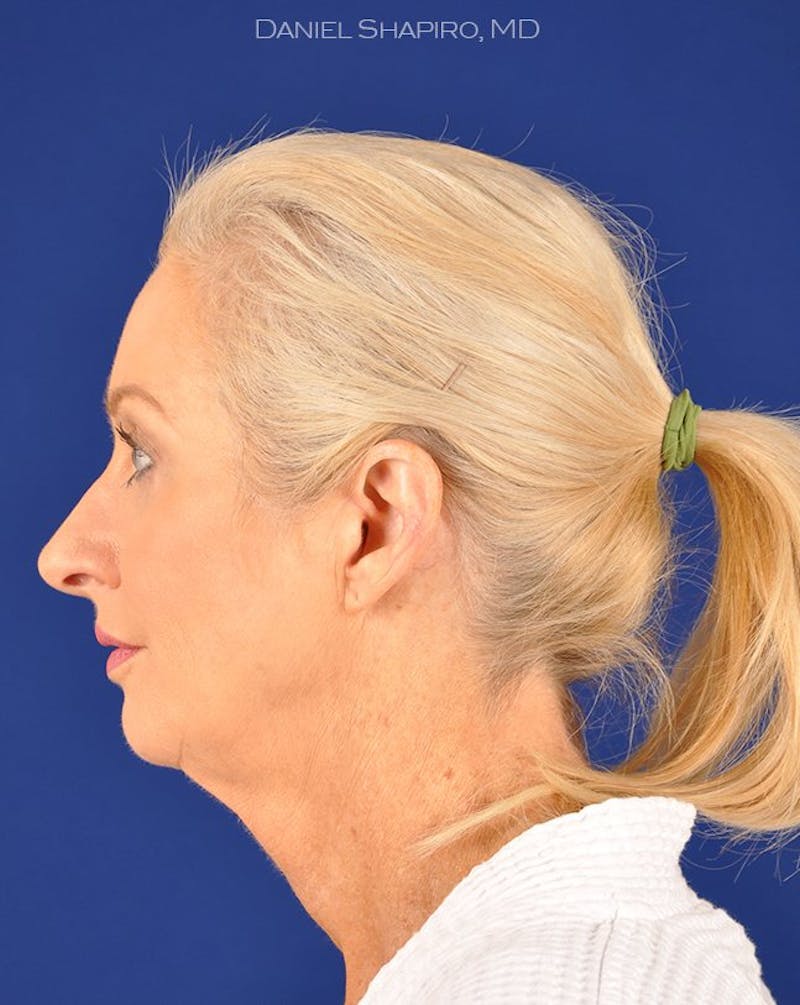 Female Rhinoplasty Before & After Gallery - Patient 17365805 - Image 5