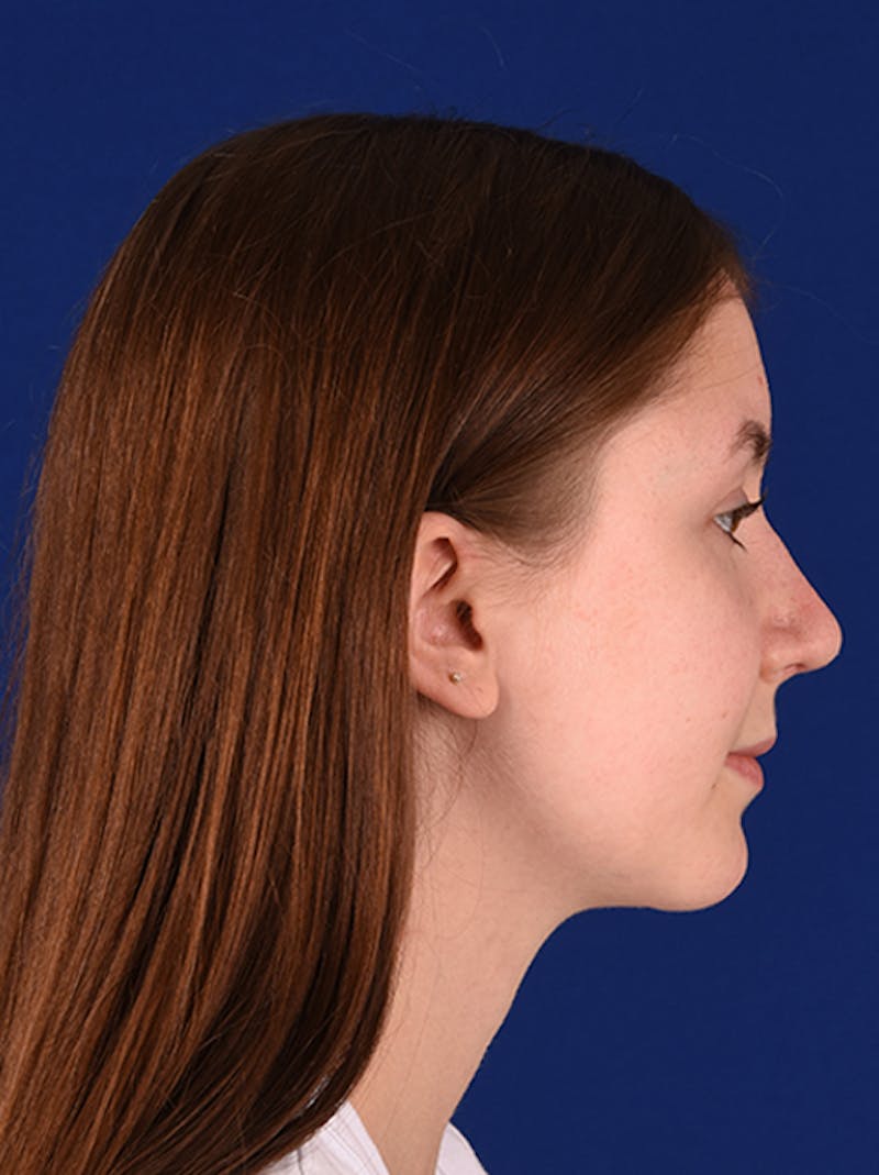 Chin Augmentation Before & After Gallery - Patient 18215209 - Image 6