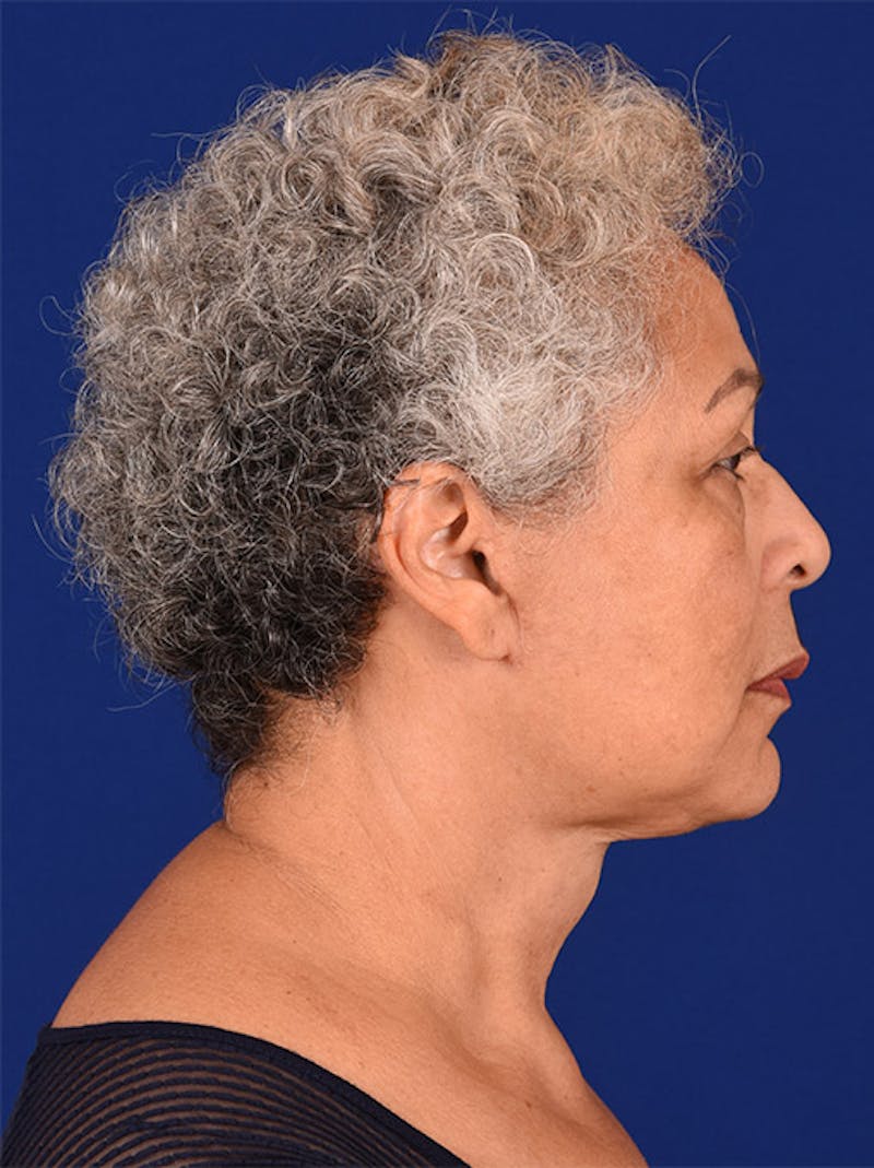 Chin Augmentation Before & After Gallery - Patient 18215296 - Image 6