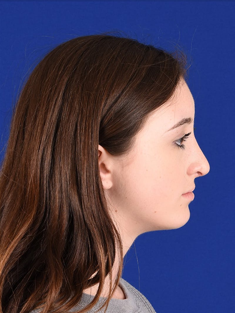 Chin Augmentation Before & After Gallery - Patient 18215594 - Image 6