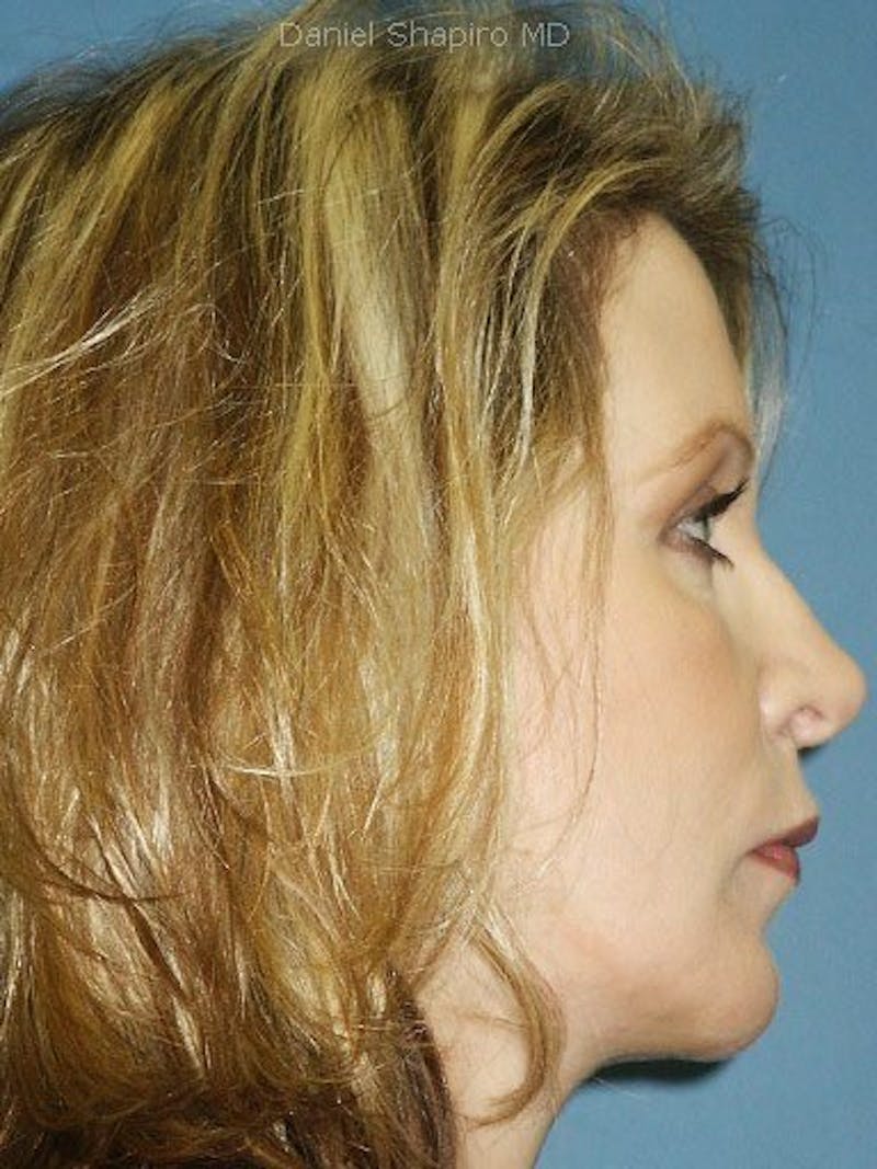 Chin Augmentation Before & After Gallery - Patient 18215654 - Image 4