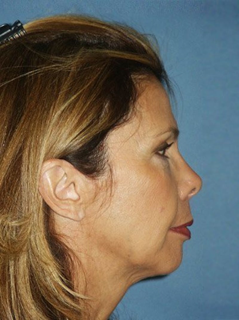 Chin Augmentation Before & After Gallery - Patient 18215668 - Image 3