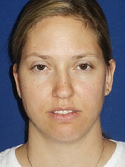 Chin Augmentation Before & After Gallery - Patient 18240508 - Image 1