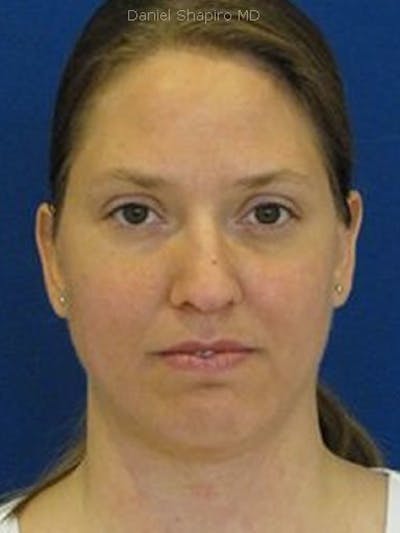 Chin Augmentation Before & After Gallery - Patient 18240508 - Image 2
