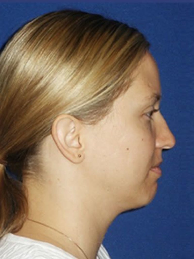 Chin Augmentation Before & After Gallery - Patient 18240508 - Image 3