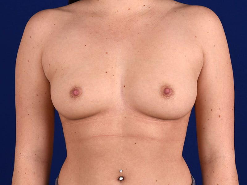 Breast Augmentation Before & After Gallery - Patient 18240776 - Image 1