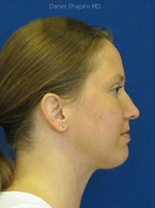 Chin Augmentation Before & After Gallery - Patient 18240508 - Image 4