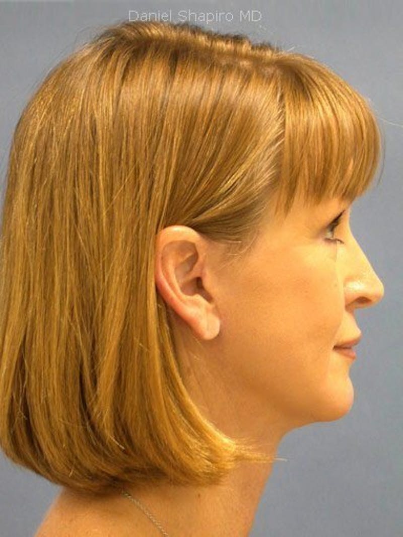 Chin Augmentation Before & After Gallery - Patient 18240777 - Image 4