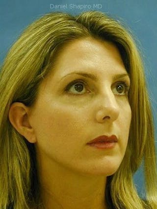 Chin Augmentation Before & After Gallery - Patient 18241051 - Image 4