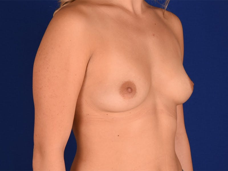 Breast Augmentation Before & After Gallery - Patient 18241056 - Image 3