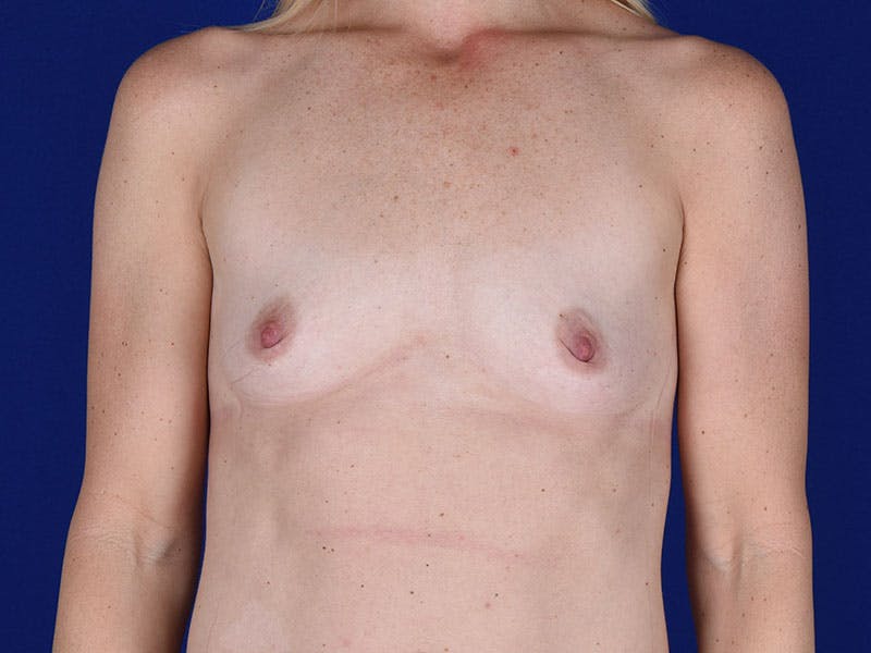 Breast Augmentation Before & After Gallery - Patient 18241070 - Image 1