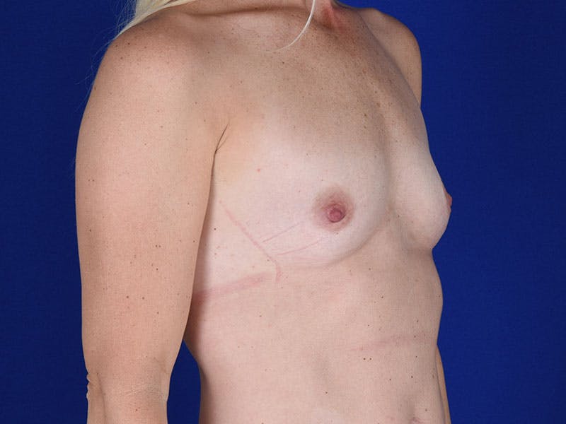 Breast Augmentation Before & After Gallery - Patient 18241070 - Image 3