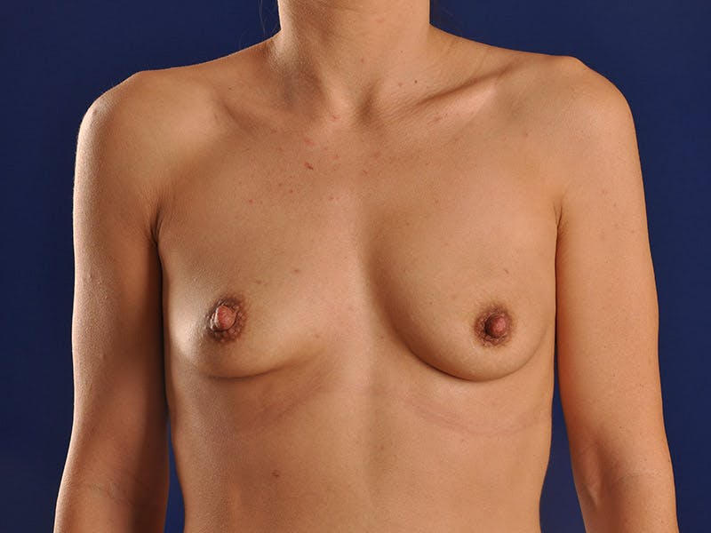 Breast Augmentation Before & After Gallery - Patient 18241093 - Image 1