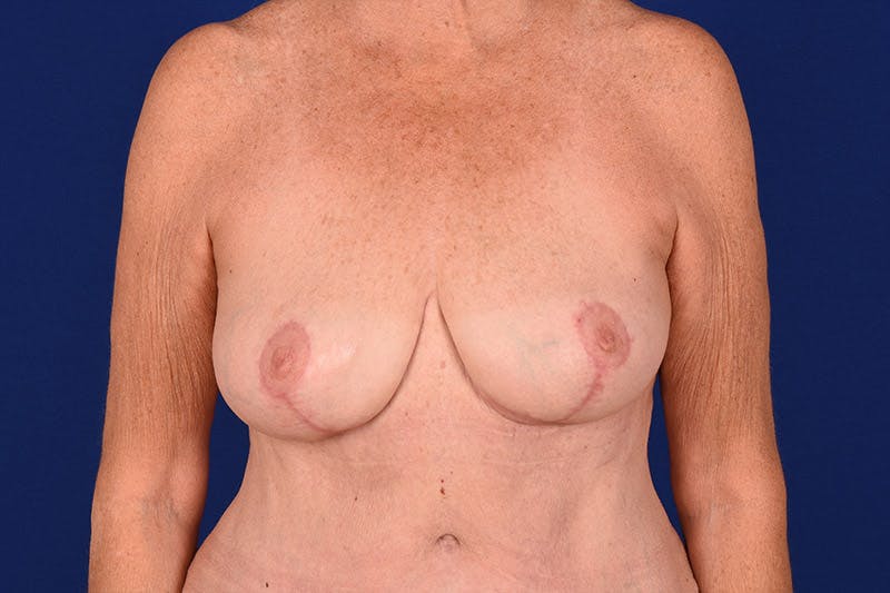 Breast Lift Before & After Gallery - Patient 18241512 - Image 2