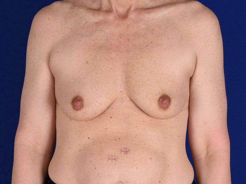 Breast Augmentation Before & After Gallery - Patient 18241520 - Image 1