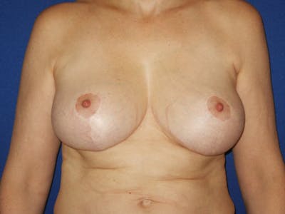 Breast Lift Before & After Gallery - Patient 18241517 - Image 2