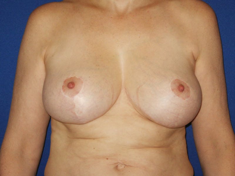 Breast Lift Before & After Gallery - Patient 18241517 - Image 2