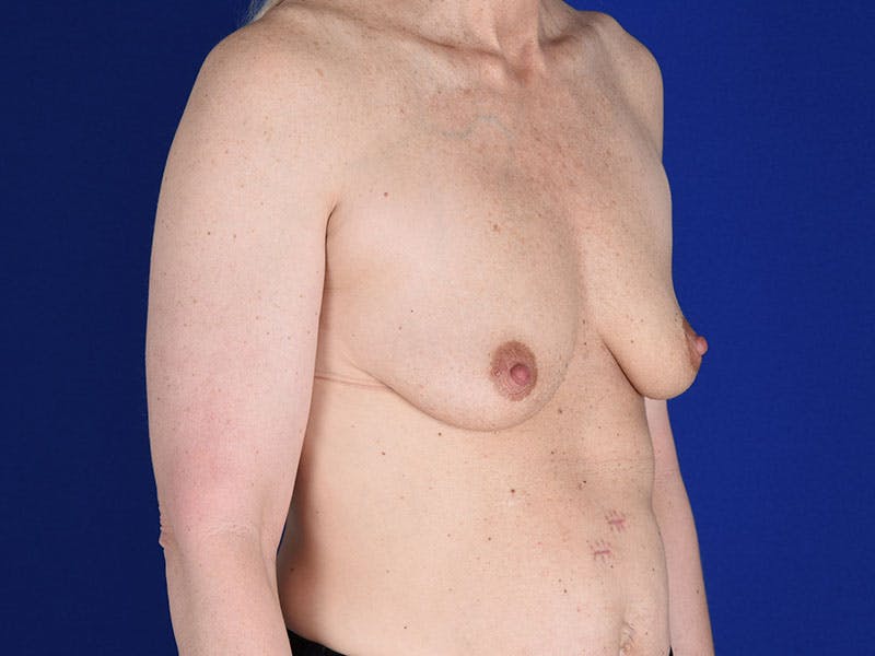 Breast Augmentation Before & After Gallery - Patient 18241520 - Image 3