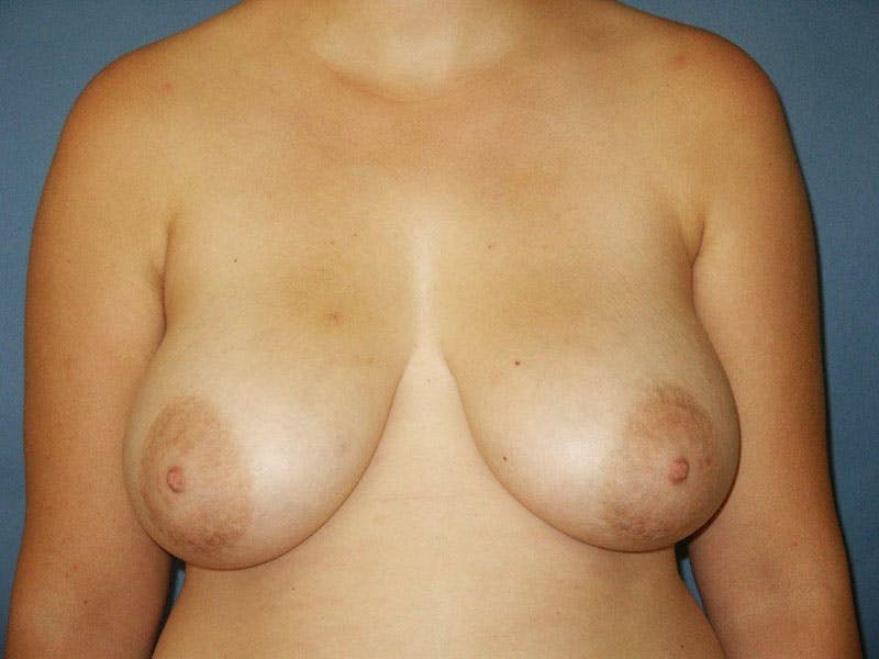 Breast Lift Before & After Gallery - Patient 18241532 - Image 1