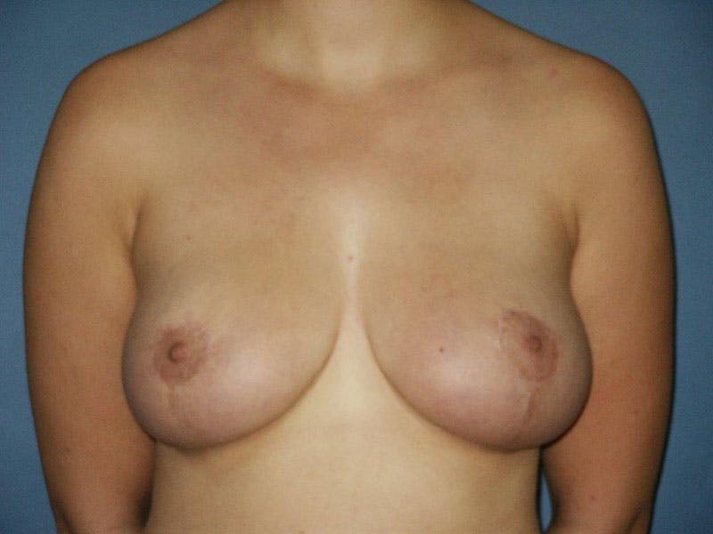 Breast Lift Before & After Gallery - Patient 18241532 - Image 2