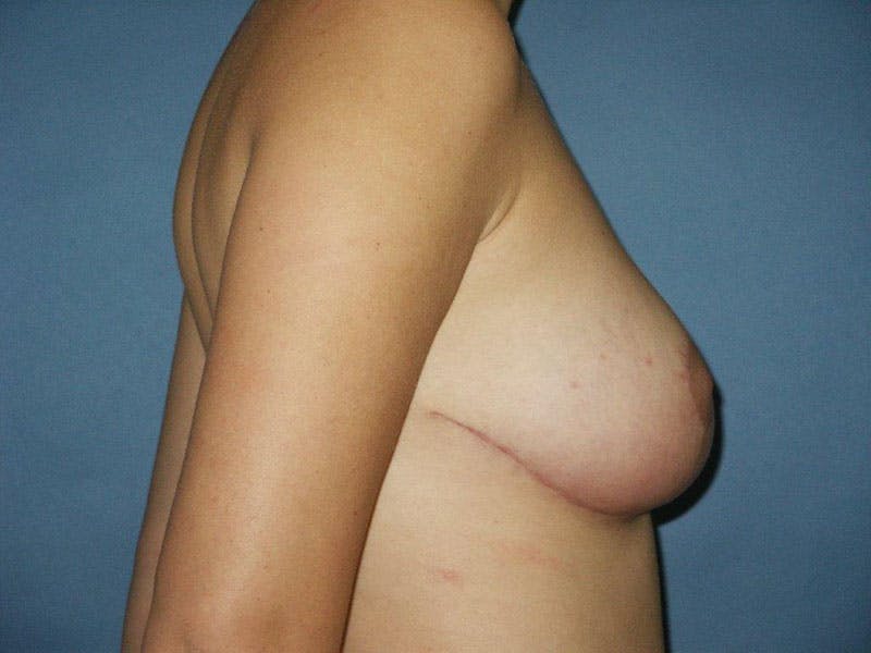 Breast Lift Before & After Gallery - Patient 18241532 - Image 6