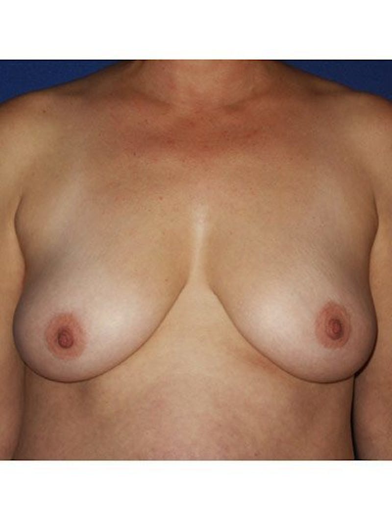 Breast Lift Before & After Gallery - Patient 18241538 - Image 1
