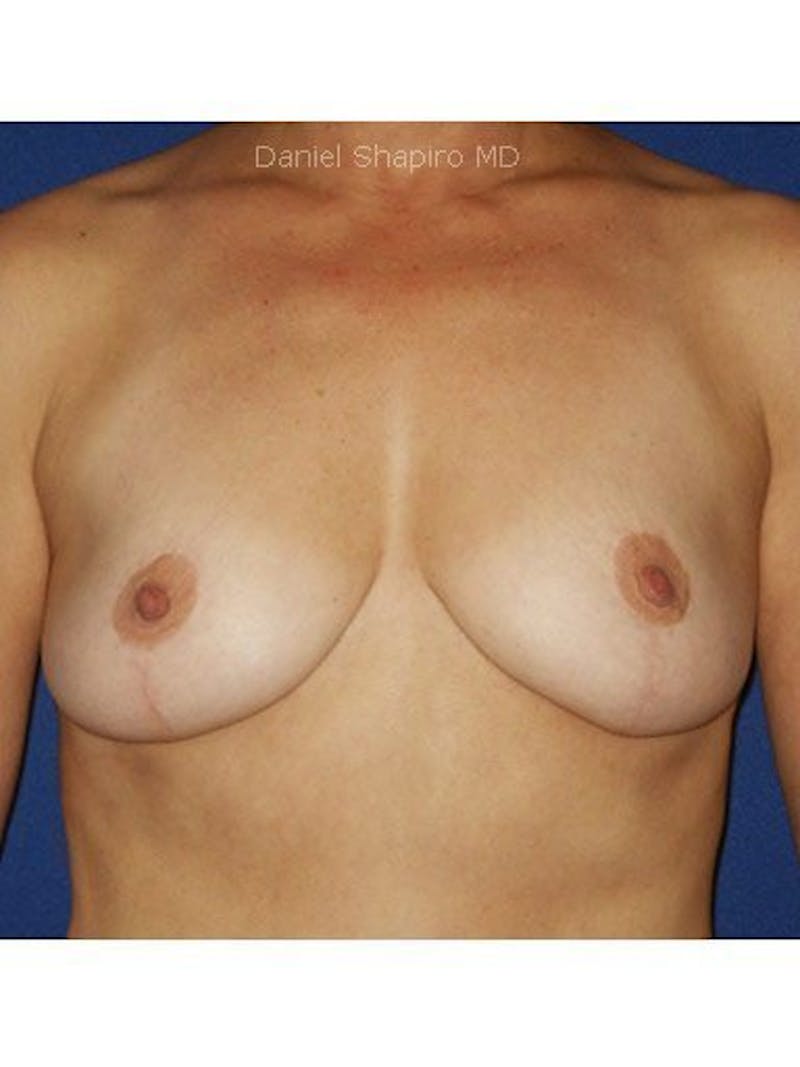 Breast Lift Before & After Gallery - Patient 18241538 - Image 2