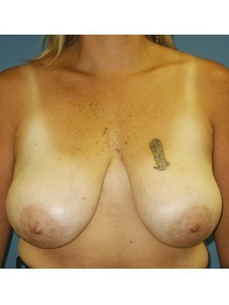 Breast Lift Before & After Gallery - Patient 18241543 - Image 1