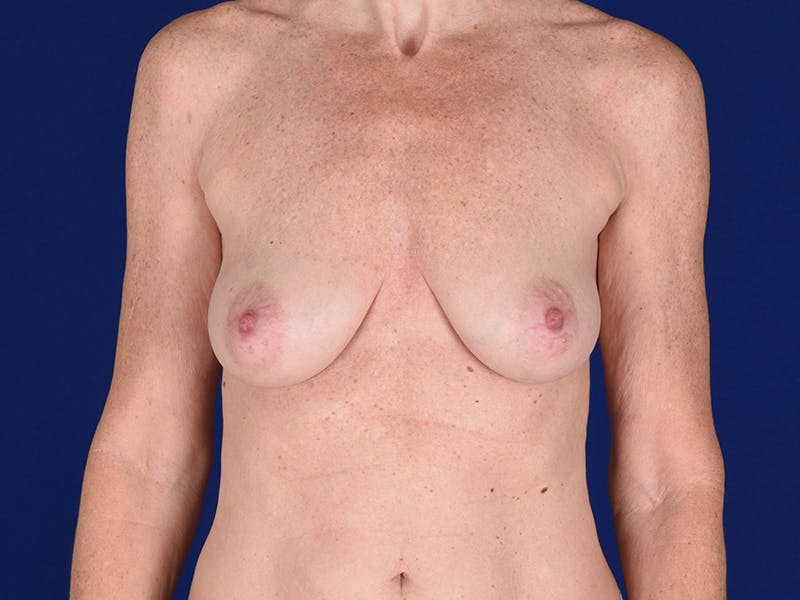 Breast Augmentation Before & After Gallery - Patient 18241553 - Image 1