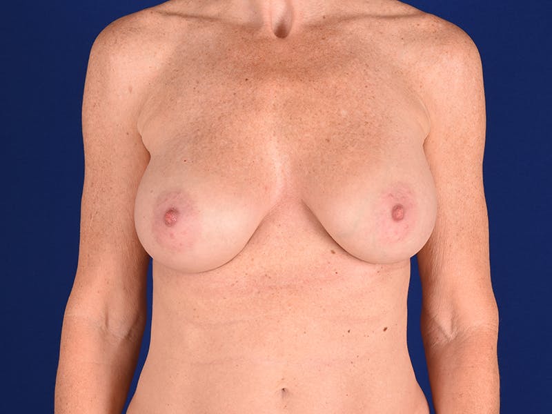 Breast Augmentation Before & After Gallery - Patient 18241553 - Image 2