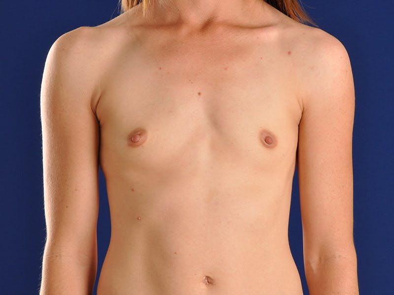 Breast Augmentation Before & After Gallery - Patient 18241557 - Image 1