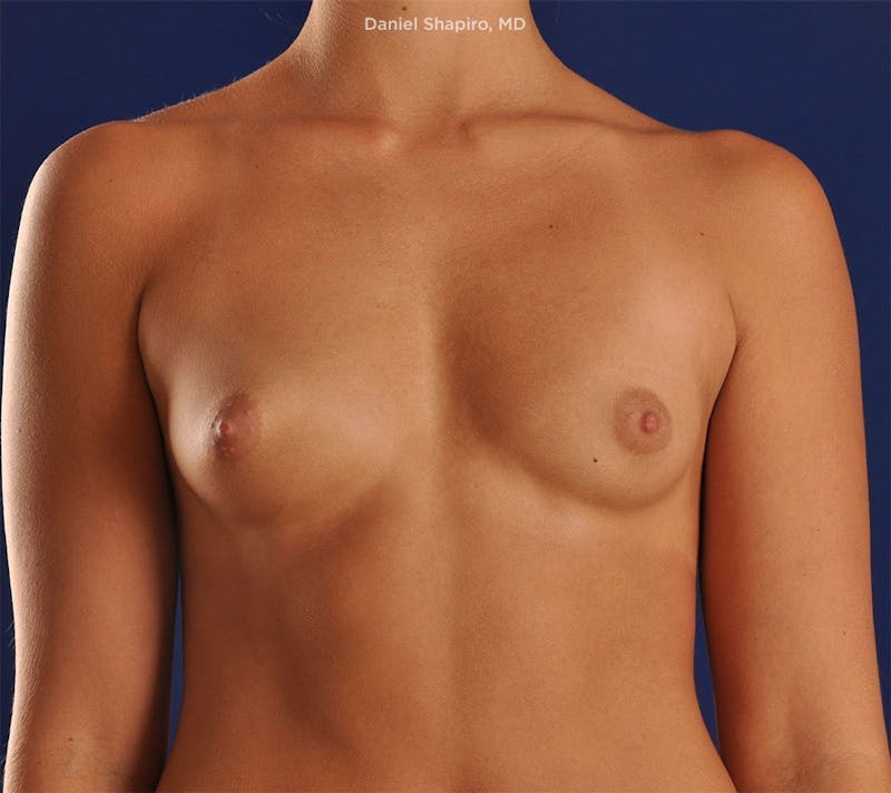 Breast Augmentation Before & After Gallery - Patient 18241562 - Image 1