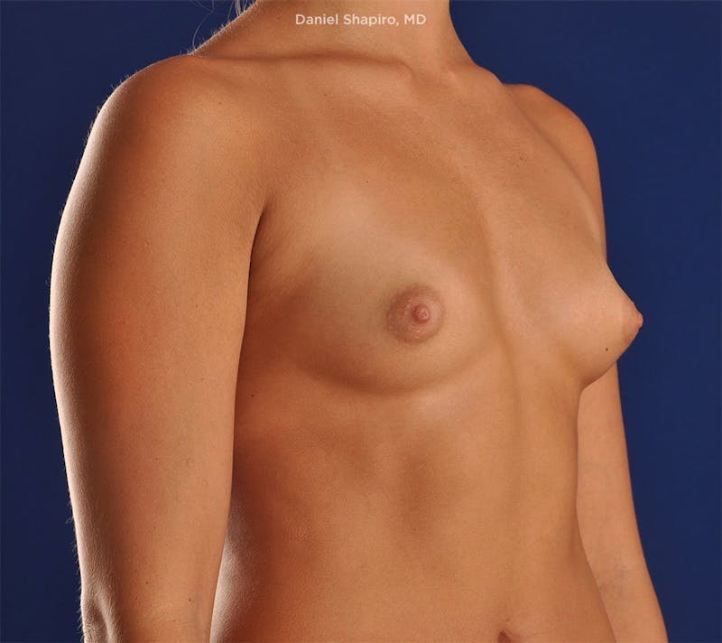 Breast Augmentation Before & After Gallery - Patient 18241562 - Image 3