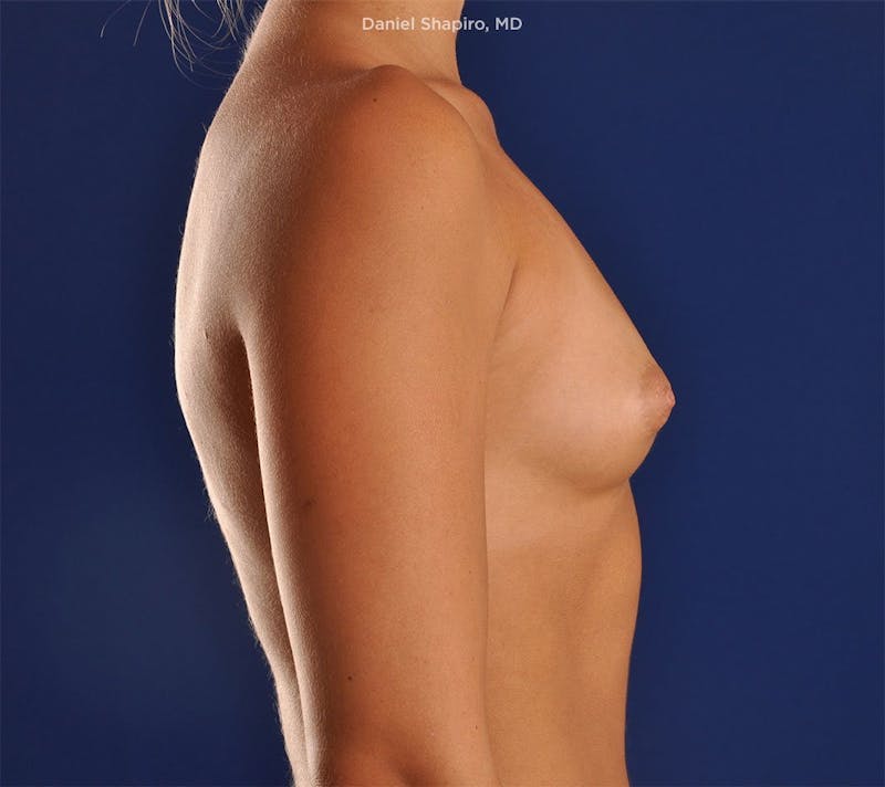 Breast Augmentation Before & After Gallery - Patient 18241562 - Image 5
