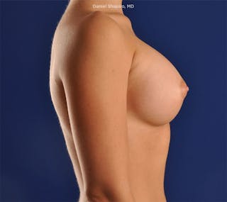 Breast Augmentation Before & After Gallery - Patient 18241562 - Image 6