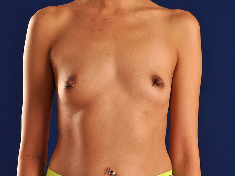Breast Augmentation Before & After Gallery - Patient 18241574 - Image 1