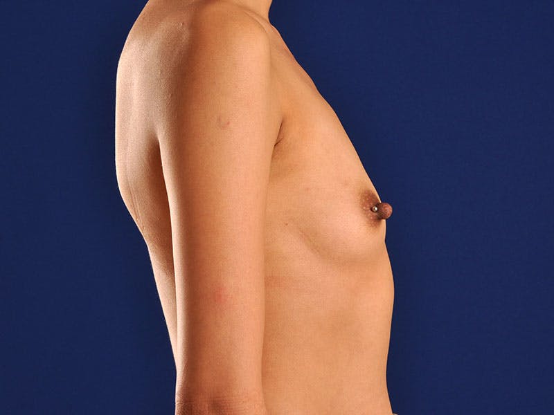 Breast Augmentation Before & After Gallery - Patient 18241574 - Image 5