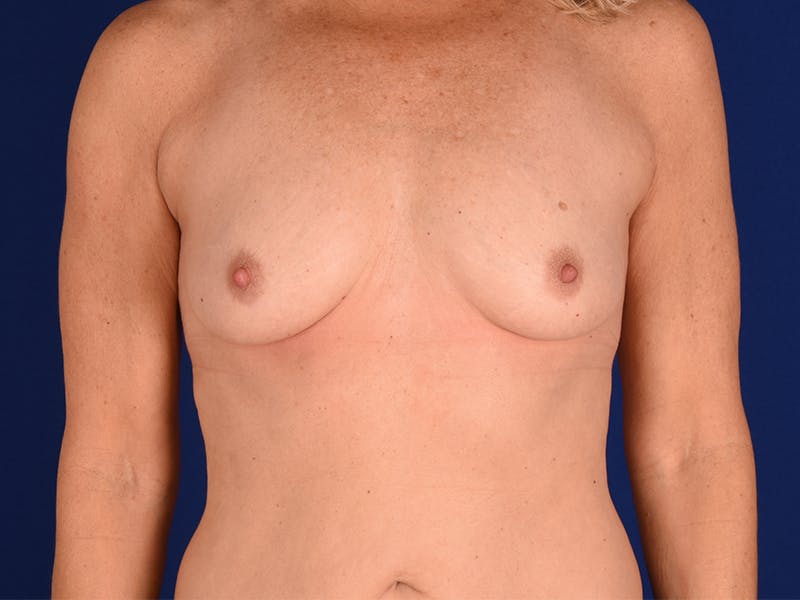 Breast Augmentation Before & After Gallery - Patient 18241702 - Image 1