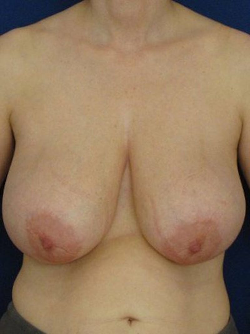 Brest Reduction Before & After Gallery - Patient 18241704 - Image 1