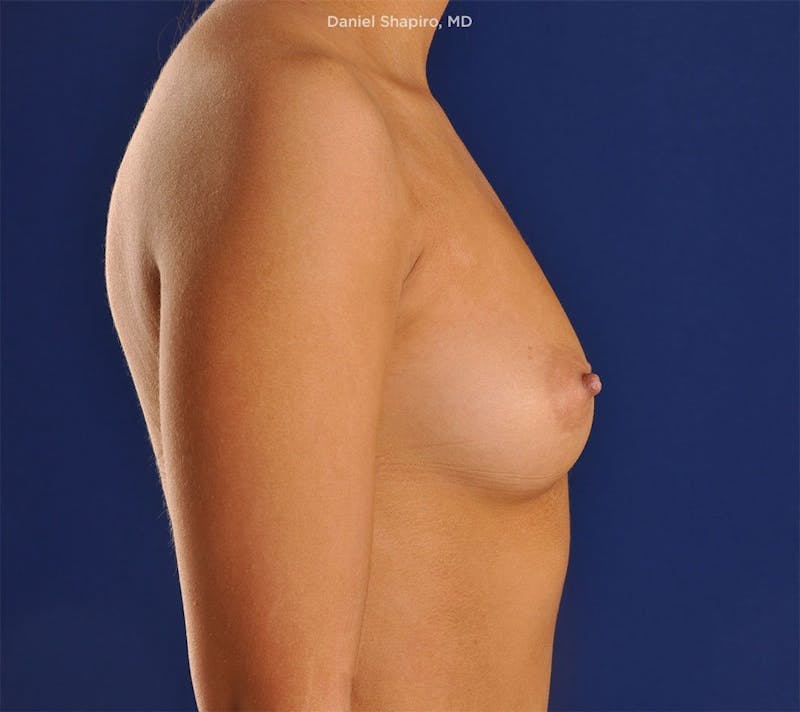 Breast Augmentation Before & After Gallery - Patient 18241846 - Image 5