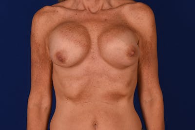Breast Surgery Revision Before & After Gallery - Patient 18241857 - Image 1