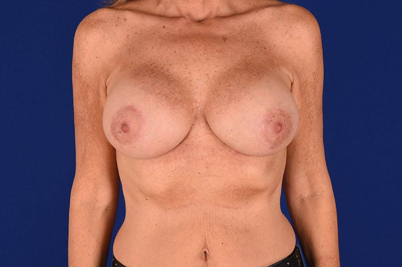 Breast Surgery Revision Before & After Gallery - Patient 18241857 - Image 2