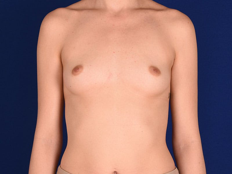 Breast Augmentation Before & After Gallery - Patient 18241871 - Image 1