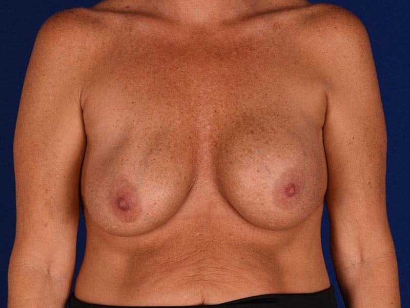 Breast Surgery Revision Before & After Gallery - Patient 18241879 - Image 1