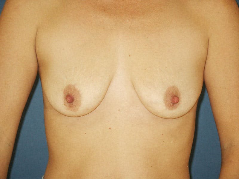 Breast Lift With Augmentation Before & After Gallery - Patient 18241878 - Image 1